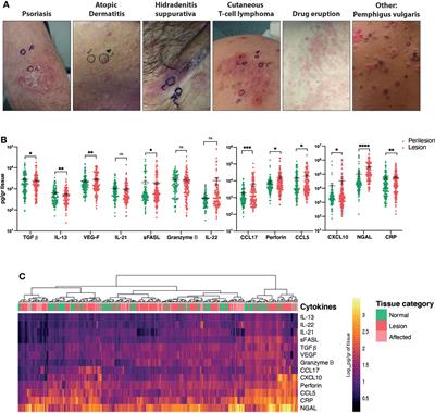 Cytokine/Chemokine assessment as a complementary diagnostic tool for inflammatory skin diseases